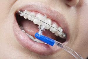 Зубна нитка (або флос), до речі, обов'язкова до застосування і після звичайної чистки